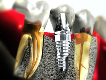 Emerging Trend der Dentistry Dental Implants
